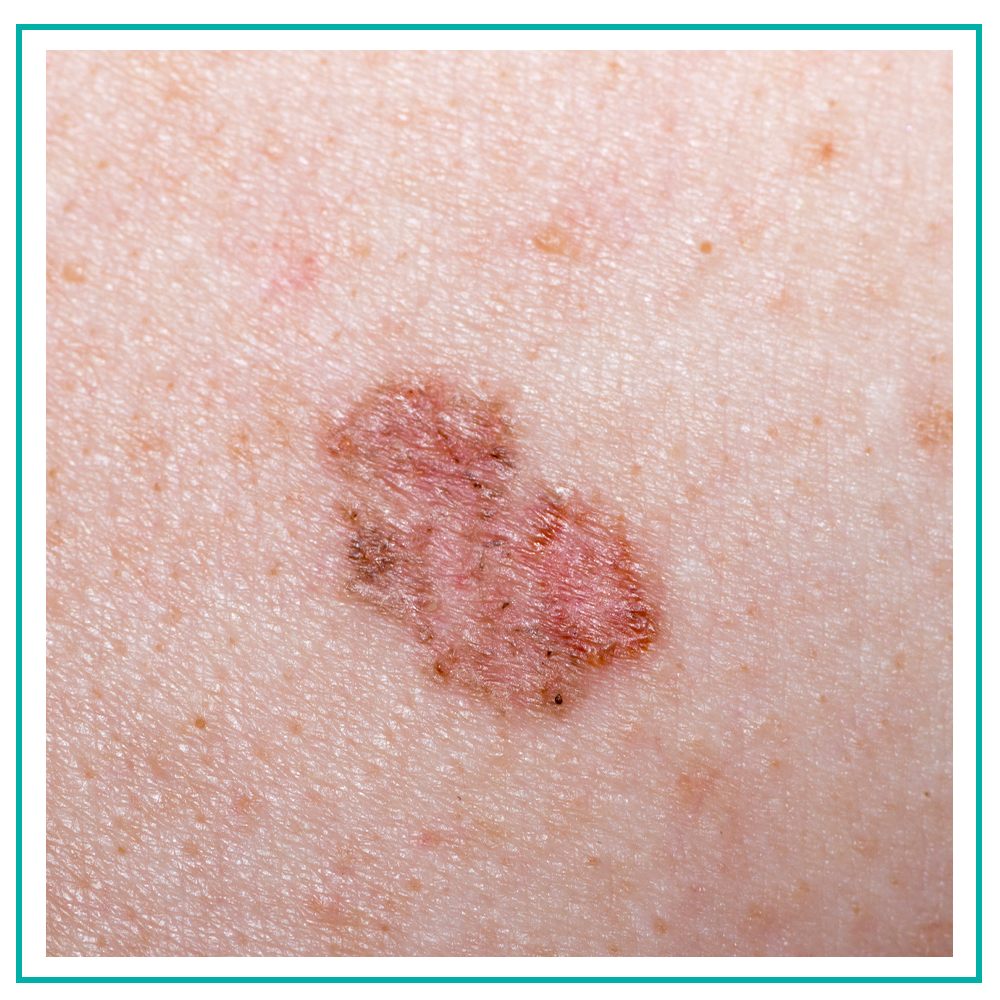 Top 95+ Images pictures of basal cell carcinoma Sharp