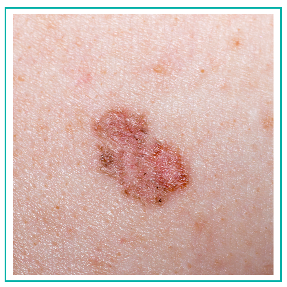 Basal Cell Carcinoma Derm And Skin Surgery Center Stockbridge Ga